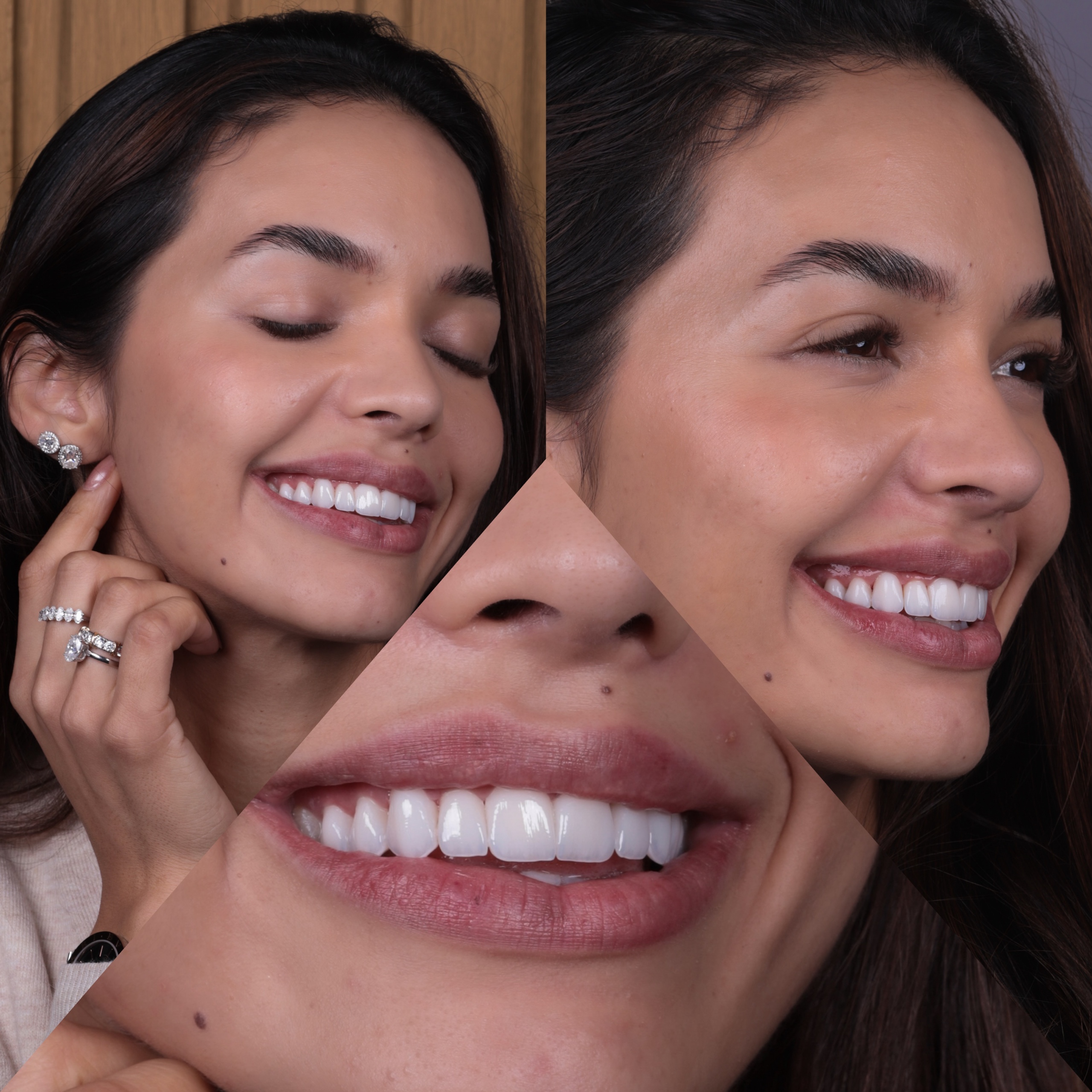Resultado de clareamento e harmonização do sorriso