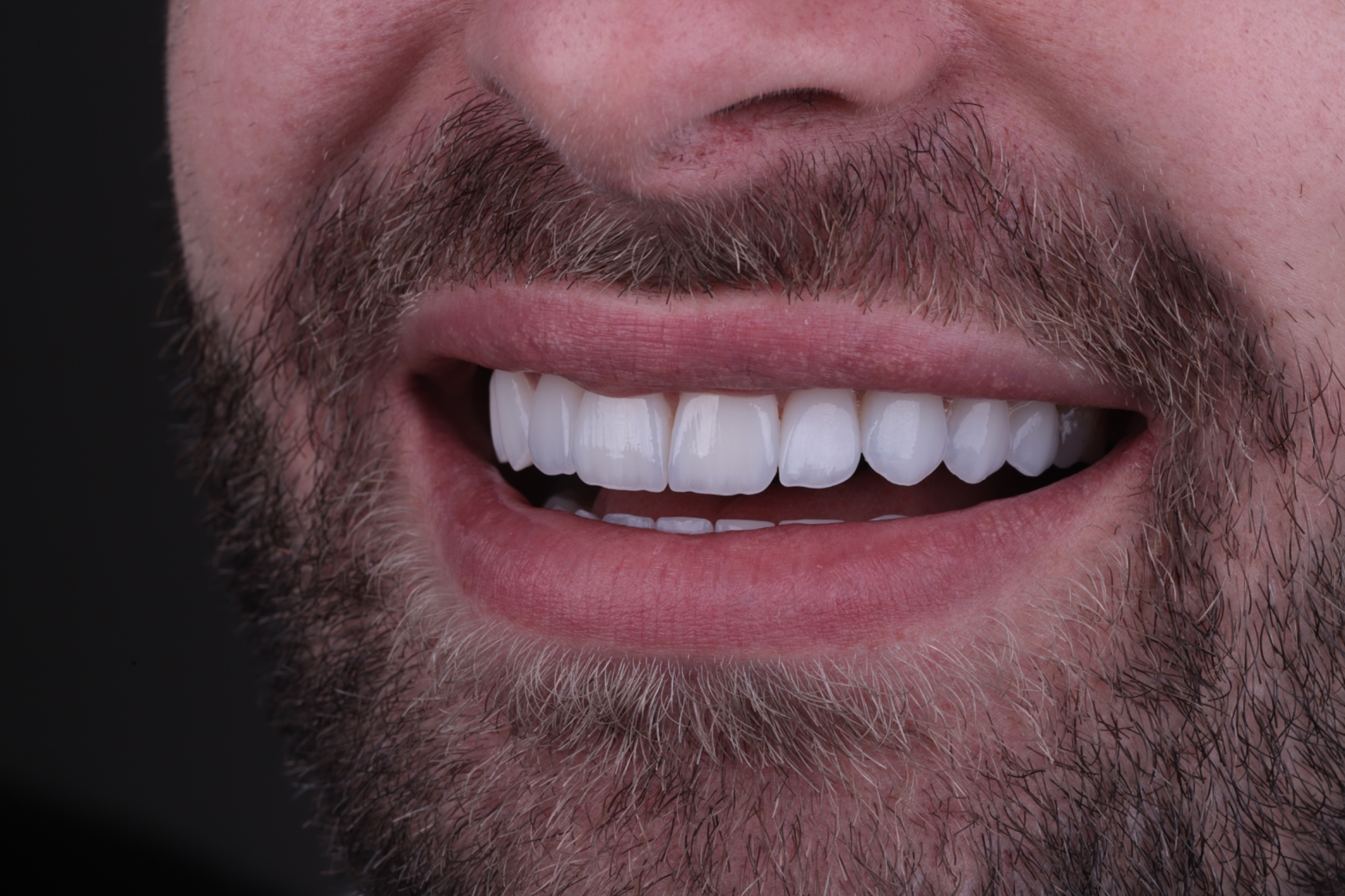 Resultado de restauração estética do sorriso