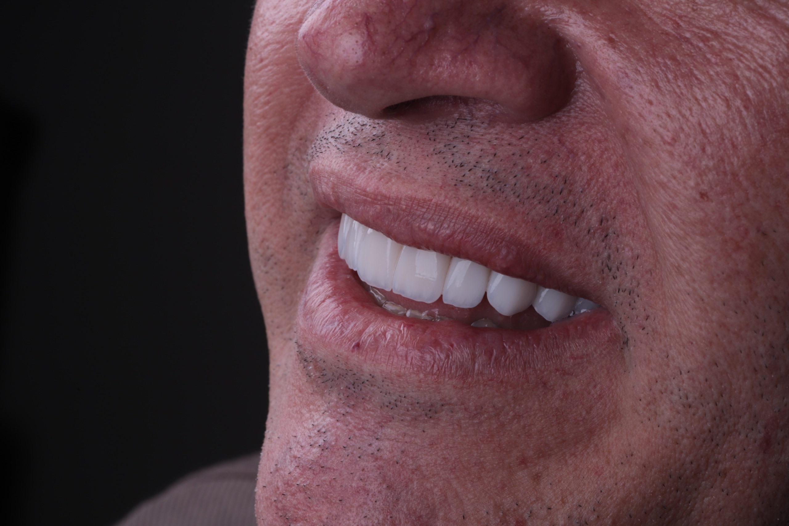 Resultado de reabilitação estética do sorriso