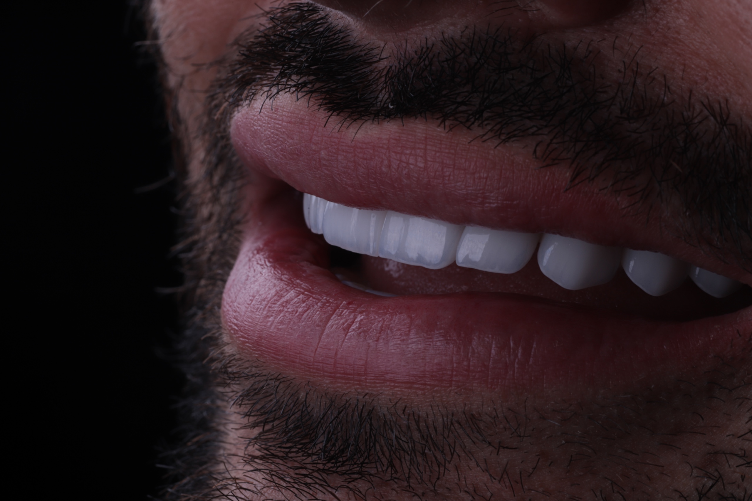 Resultado de restauração estética do sorriso