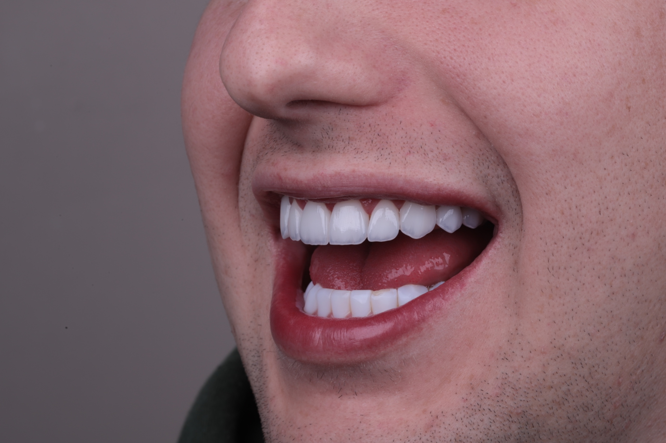 Resultado de harmonização do sorriso